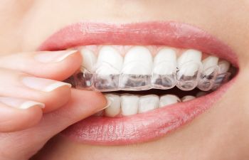 Woman imposing Invisalign aligner on teeth