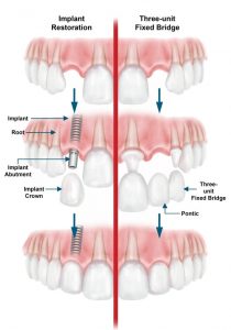 Diagram of the procedure for mounting dental implants