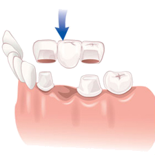 Tooth bridge