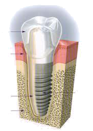 Tooth implant model