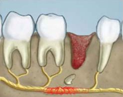 Drawing of the inside of the mouth showing the damaged nerve of the tooth.