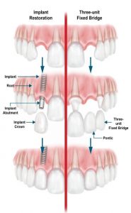 Diagram of the procedure for mounting dental implants