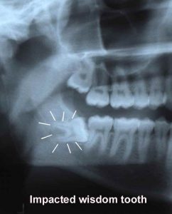 X-ray picture of teeth
