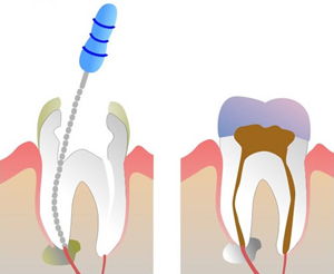 Drawing of the cross section of the dental canals