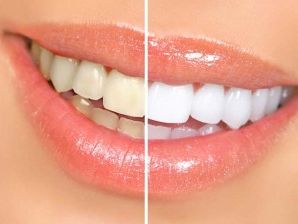 Comparison of teeth with tincture and bleached teeth