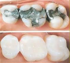 Teeth with colored fillings