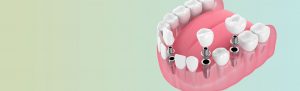 Jaw model with dental implants