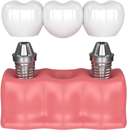 Dental bridge model based on implants