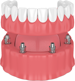 All-on-4 Implant Support Dentures