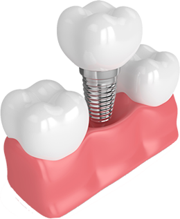 Model of a single dental implant