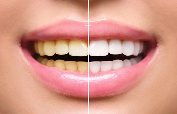 Teeth Whitening Marietta GA