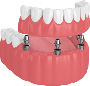 Implant-Supported Denture